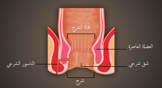 صورة ناسور الشرج