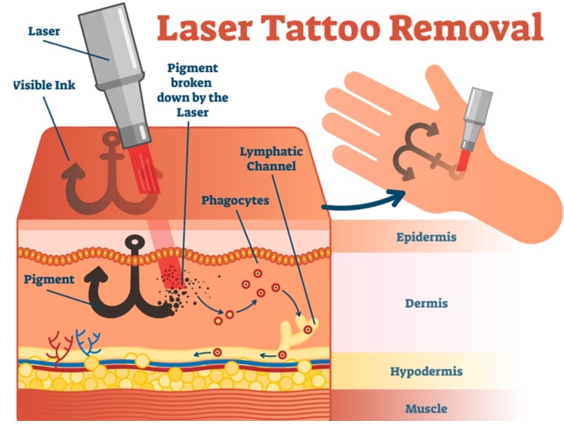 طريقة إزالة الوشم بالليزر