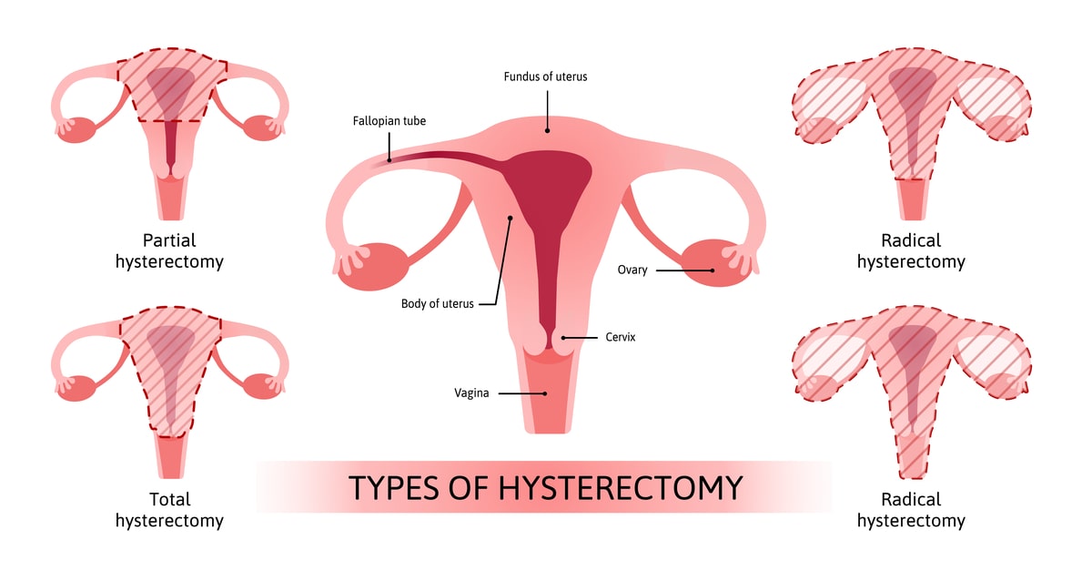 صورة أنواع استئصال الرحم