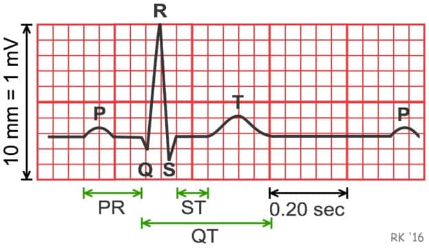 صورة تخطيط القلب الكهربائي