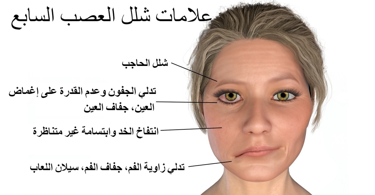 علامات شلل العصب السابع شلل بيل