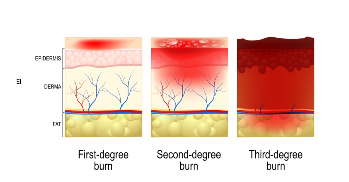 صورة درجات الحروق