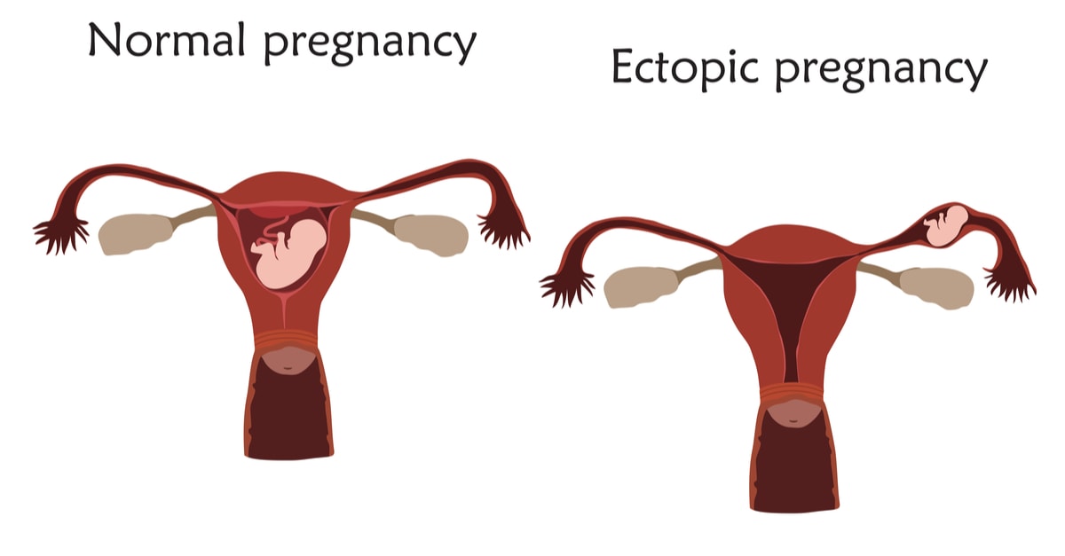 صورة الحمل خارج الرحم