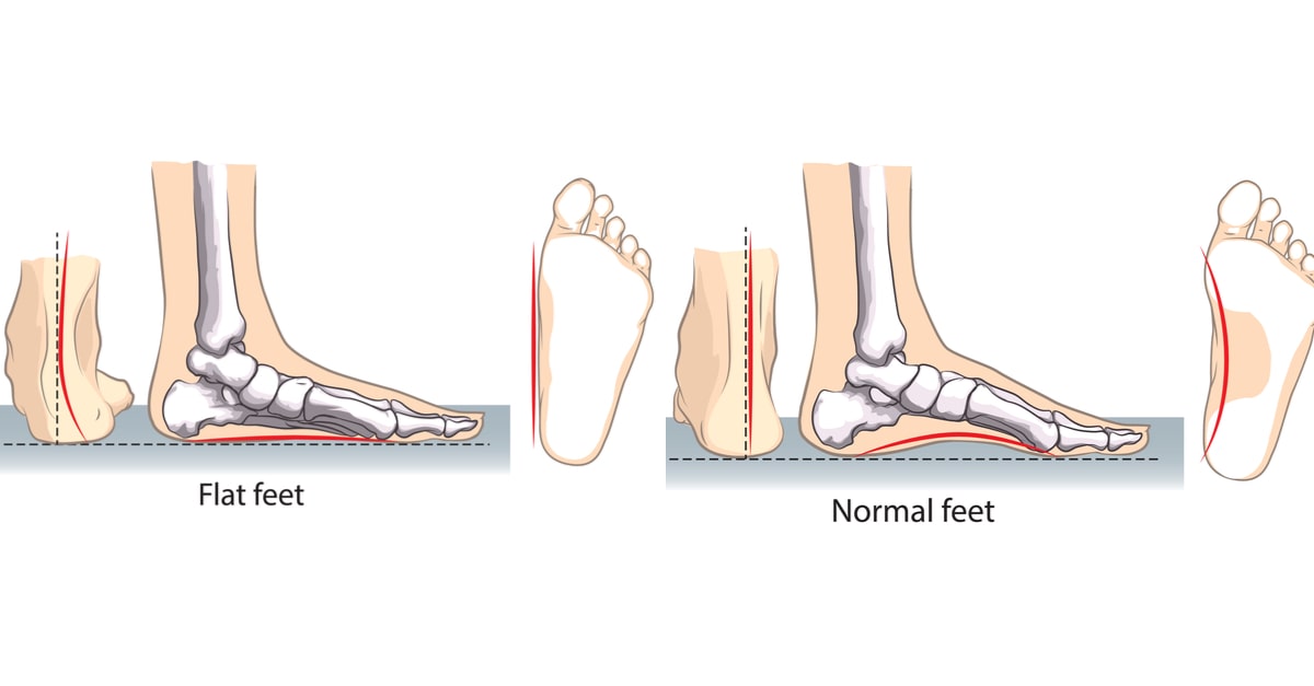 الفرق بين القدم المسطحة والقدم الطبيعية
