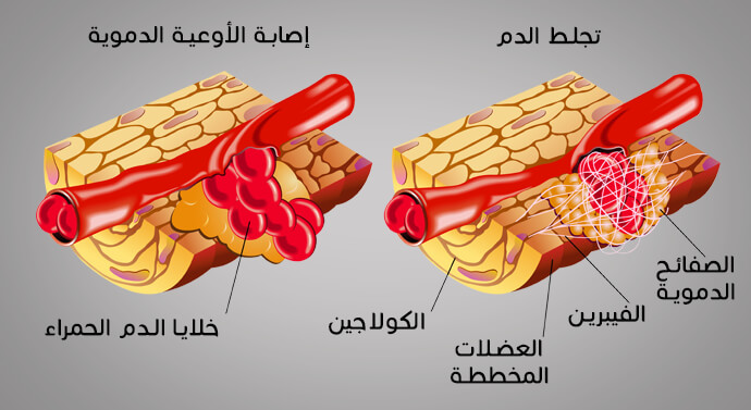 صورة الصفائح الدموية