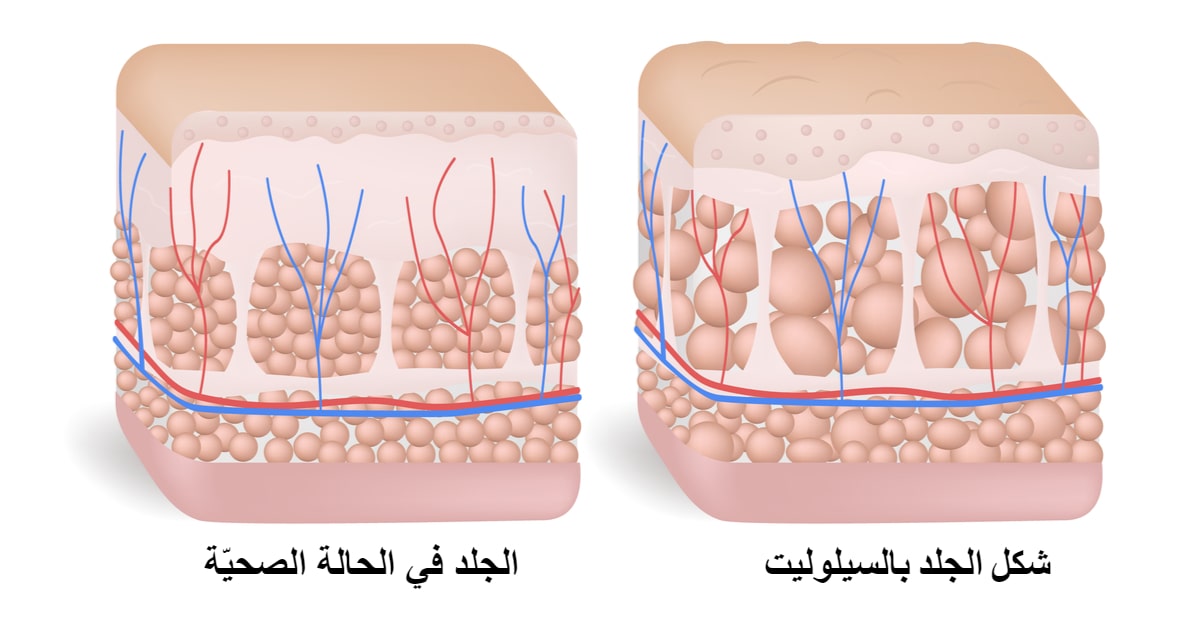 صورة شكل السيلوليت