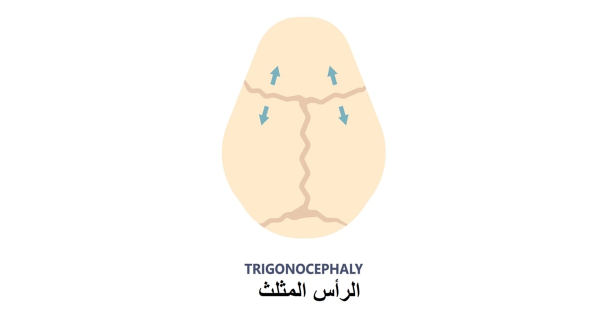 بروز جبهة الطفل بالشكل المثلث