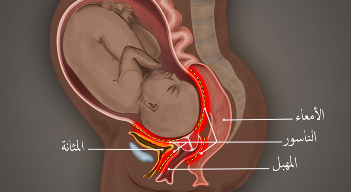 صورة ناسور الولادة