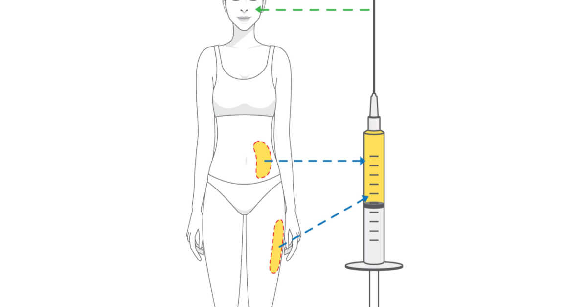 طريقة حقن الدهون الذاتية صورة توضيحية